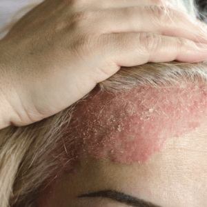 Psoriasis