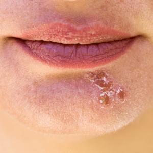 Herpes