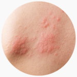 Eva Maria Kraus - Herpes